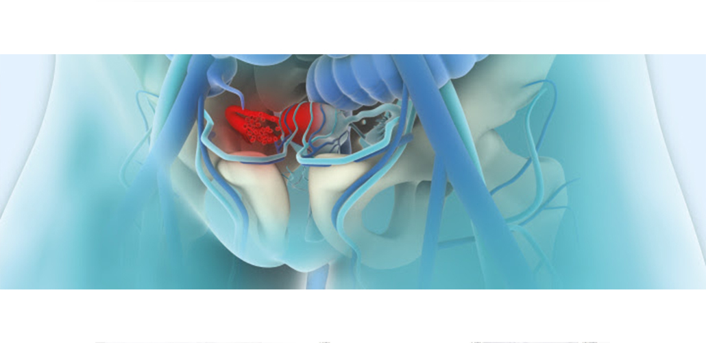 How recent miRNA studies are providing new insights into ovarian cancer from Qiagen!